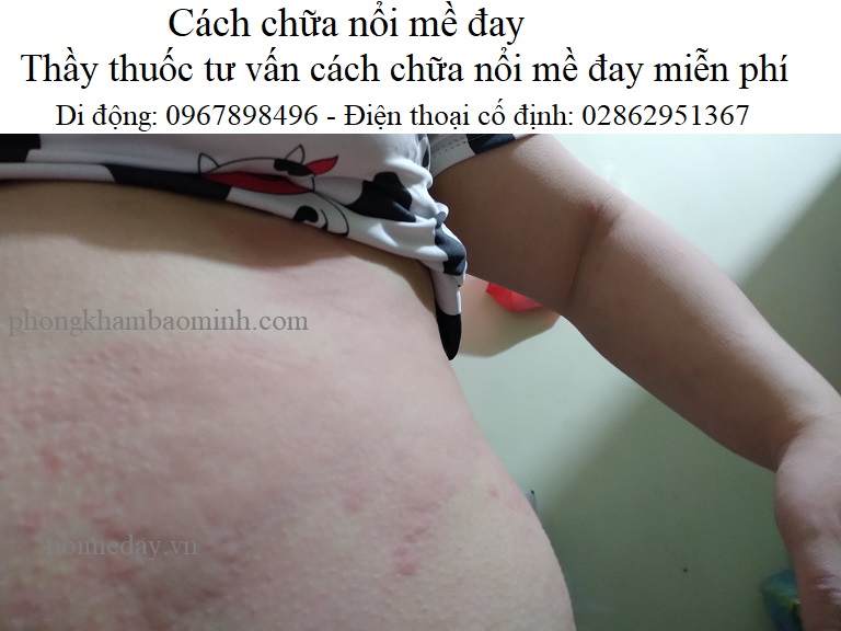 Cách chữa nổi mề đay